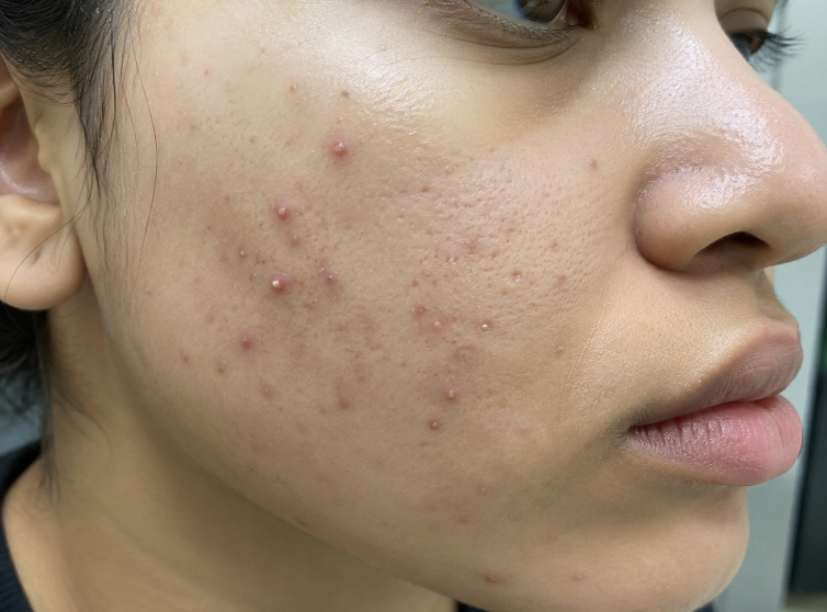 Acne & Oily Skin
