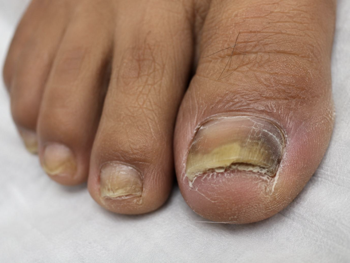 Nail Disorders